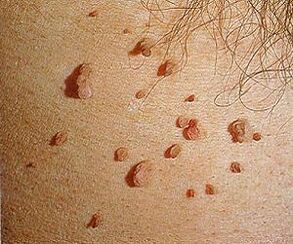 хуман папиломавирус на кожата