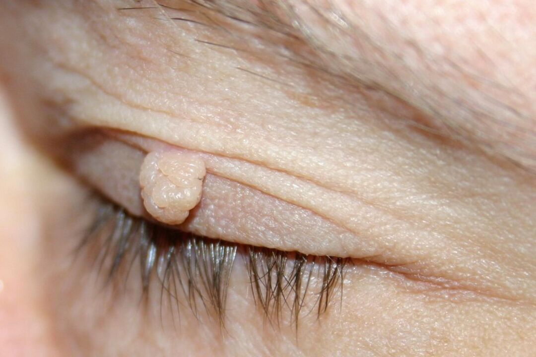 симптоми на папилома на очниот капак